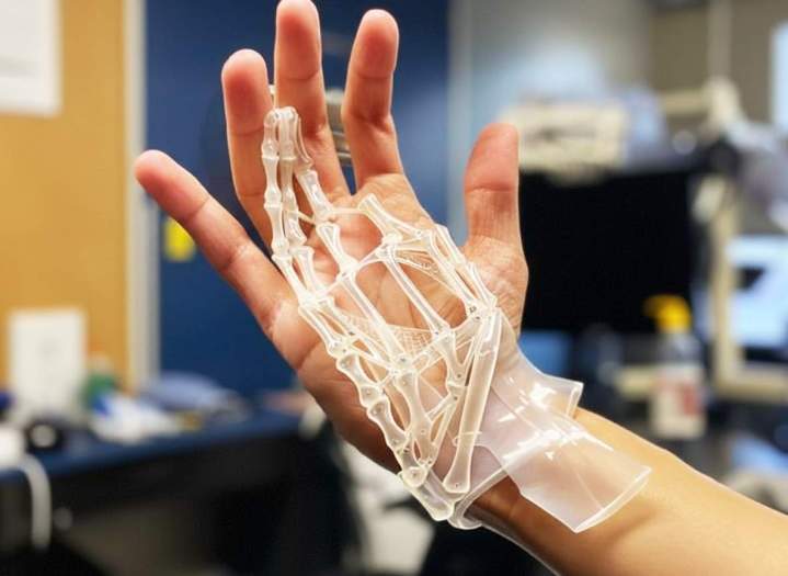 Orthèse des mains sur mesure Bras-Panon