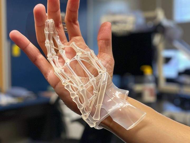 Orthèses personnalisées pour les mains à La Réunion